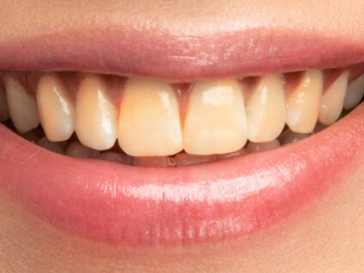 How to Fix One Discolored Tooth: Long-Term Solutions