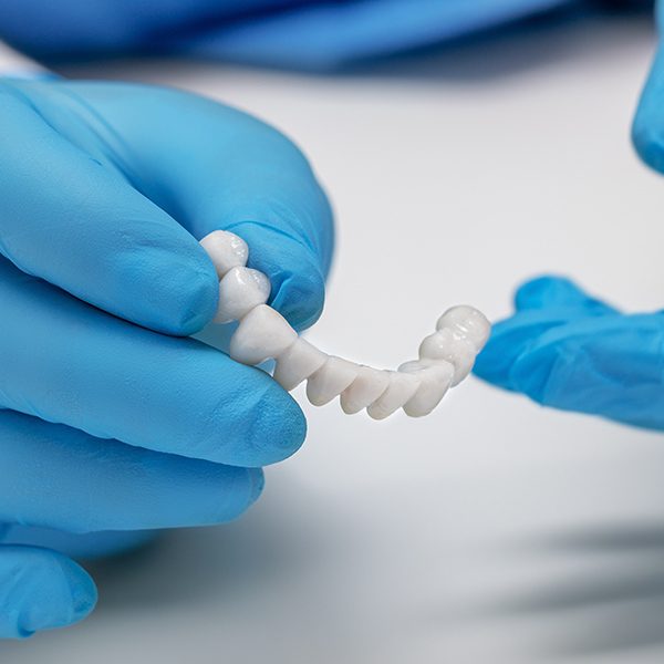 Dental-Bridges