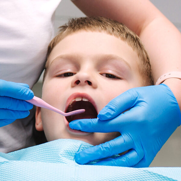 Dental-Sealants