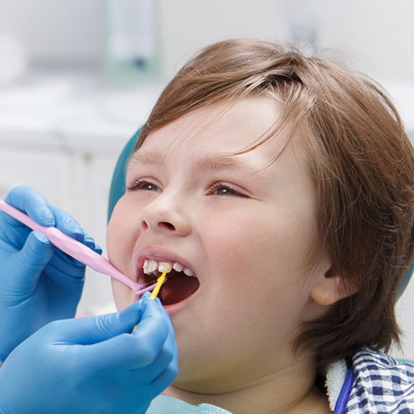 Fluoride-Treatment-in-Dallas