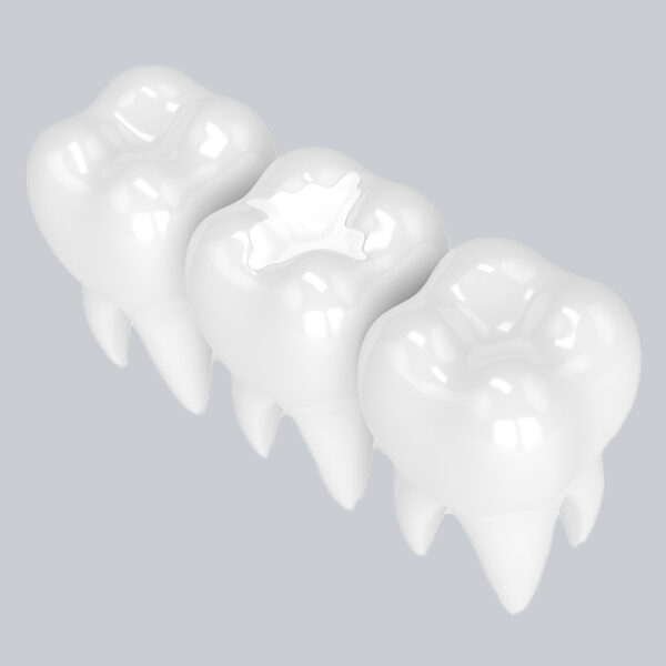 White-Colored-Fillings